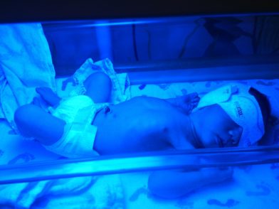 アメリカで出産 新生児黄疸と光線治療